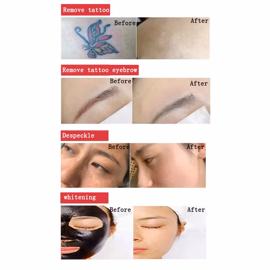 Instrumento de beleza Pico Second Laser Máquinas de remoção de tatuagem Máquina Pico Laser portátil Laser Picosecond